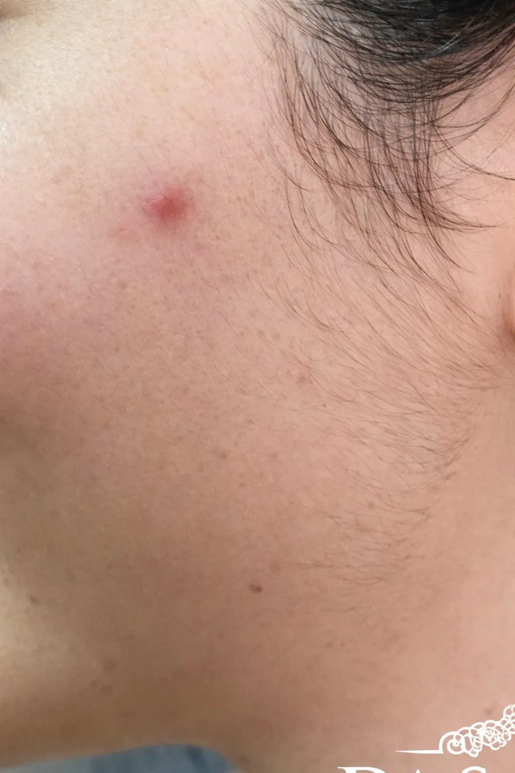 Before Face Waxing Services At US Hairline Selon