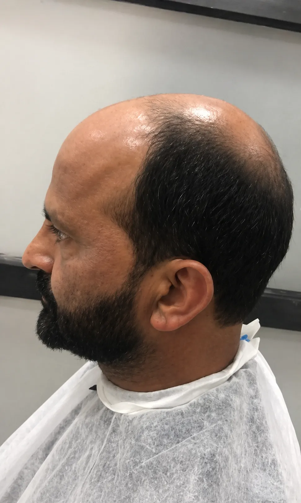 Before Hair Patch for Men At US Hairline Salon