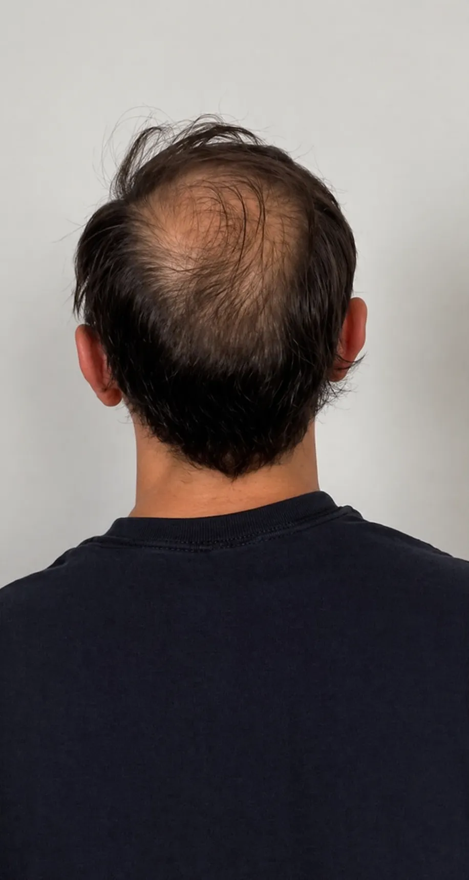 Before Hair Patch for Men At US Hairline Salon.