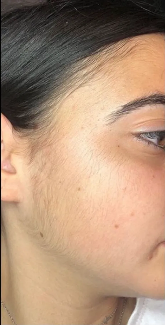 Before Hair Remove At US hairline