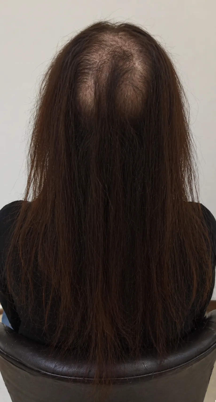 Hair Patch for Women Before Transformation At US Hairline
